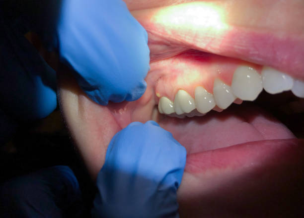 Best Emergency Dental Filling Replacement  in Oakes, ND